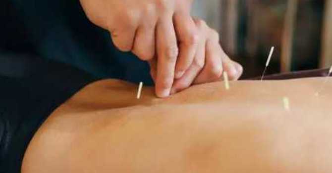 Needles for Healing: The Rising Popularity of Dry Needling Therapy image