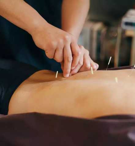 Dry Needling treatment in Texas