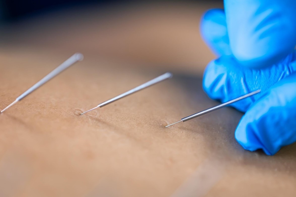 Dry Needling treatment in Texas