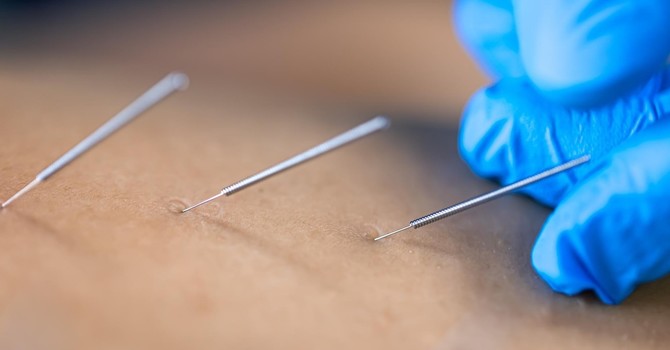 Unveiling the Science Behind Dry Needling Therapy