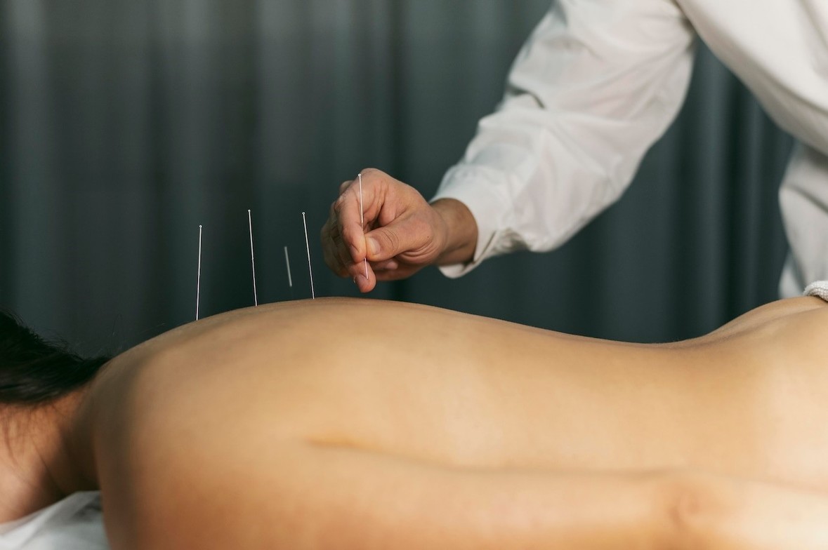 dry needling therapy Texas