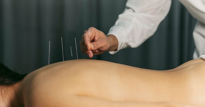 Needle Away Pain: Exploring Dry Needling Therapy image